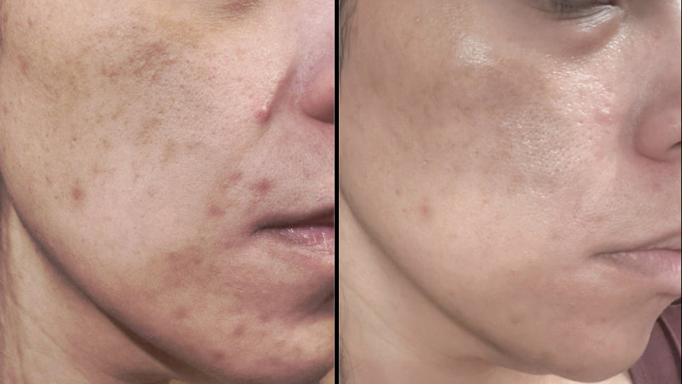 Before and after comparison of a person's face with visible skin texture and blemishes.